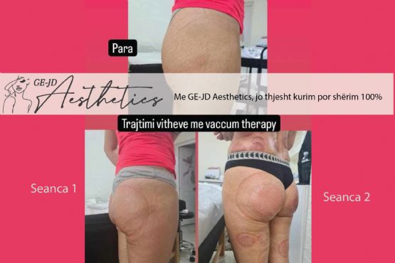 Ngritje vitheve me kupa vaccum therapy, Trajtim i vitheve me vakum, Ngri...